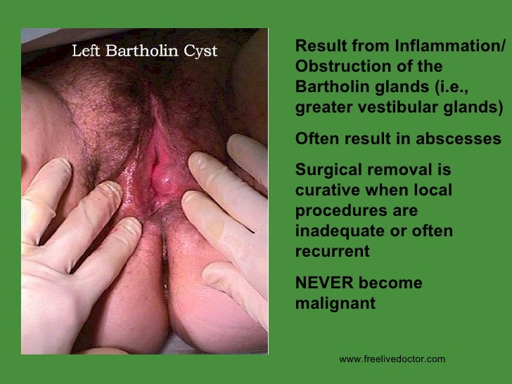 infected gland in vagina Ebony horny sex